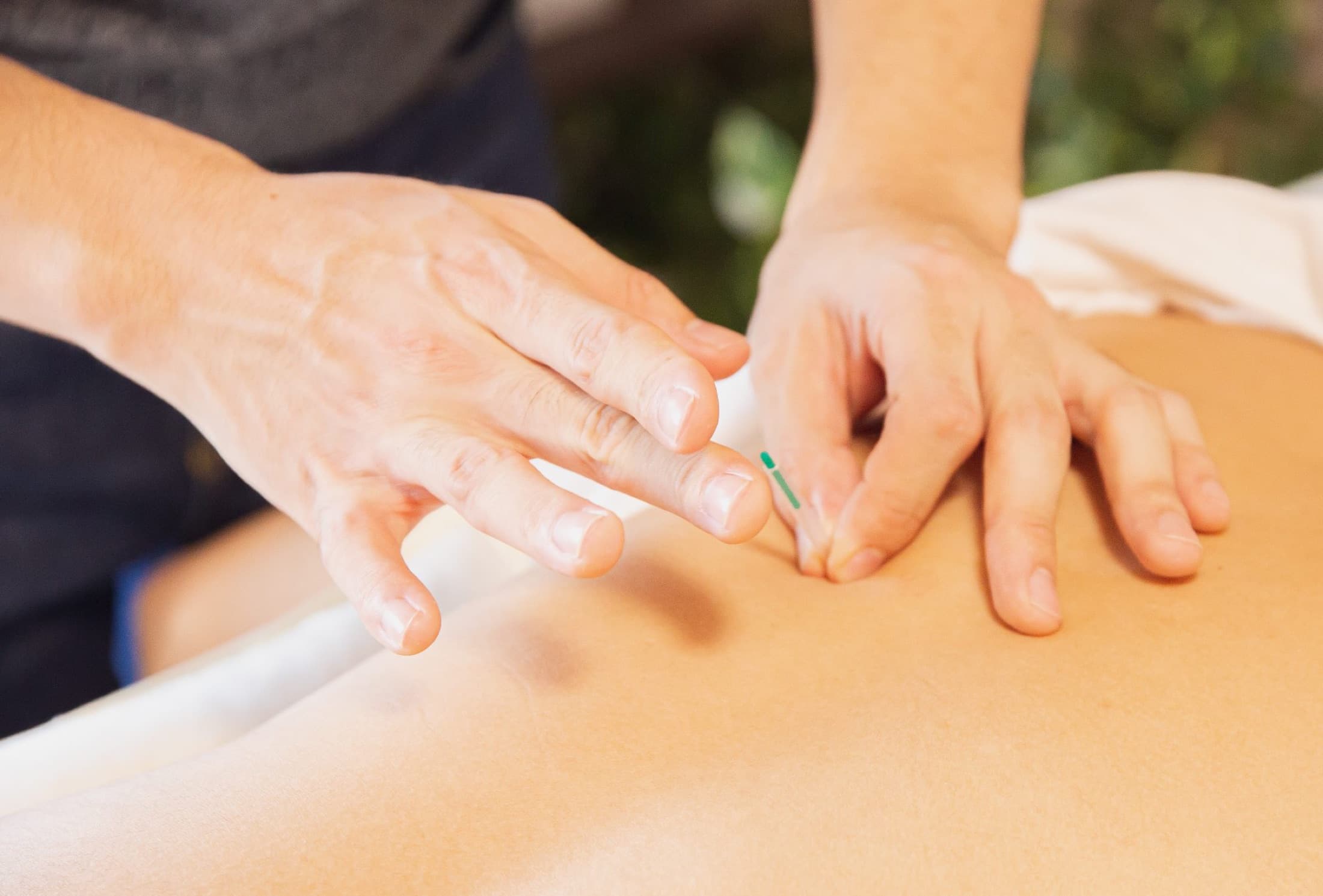 Close-up of a practitioner's hands placing a fine acupuncture needle in a patient's back
